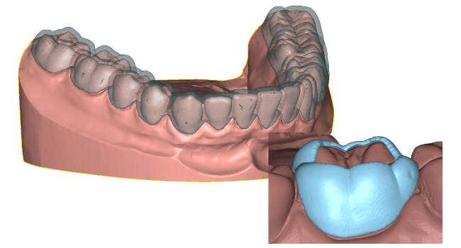 Appliance clear aligner molar band 3D dental model DeltaFace 