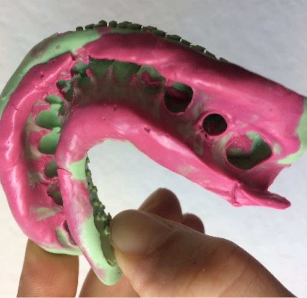 dental impression