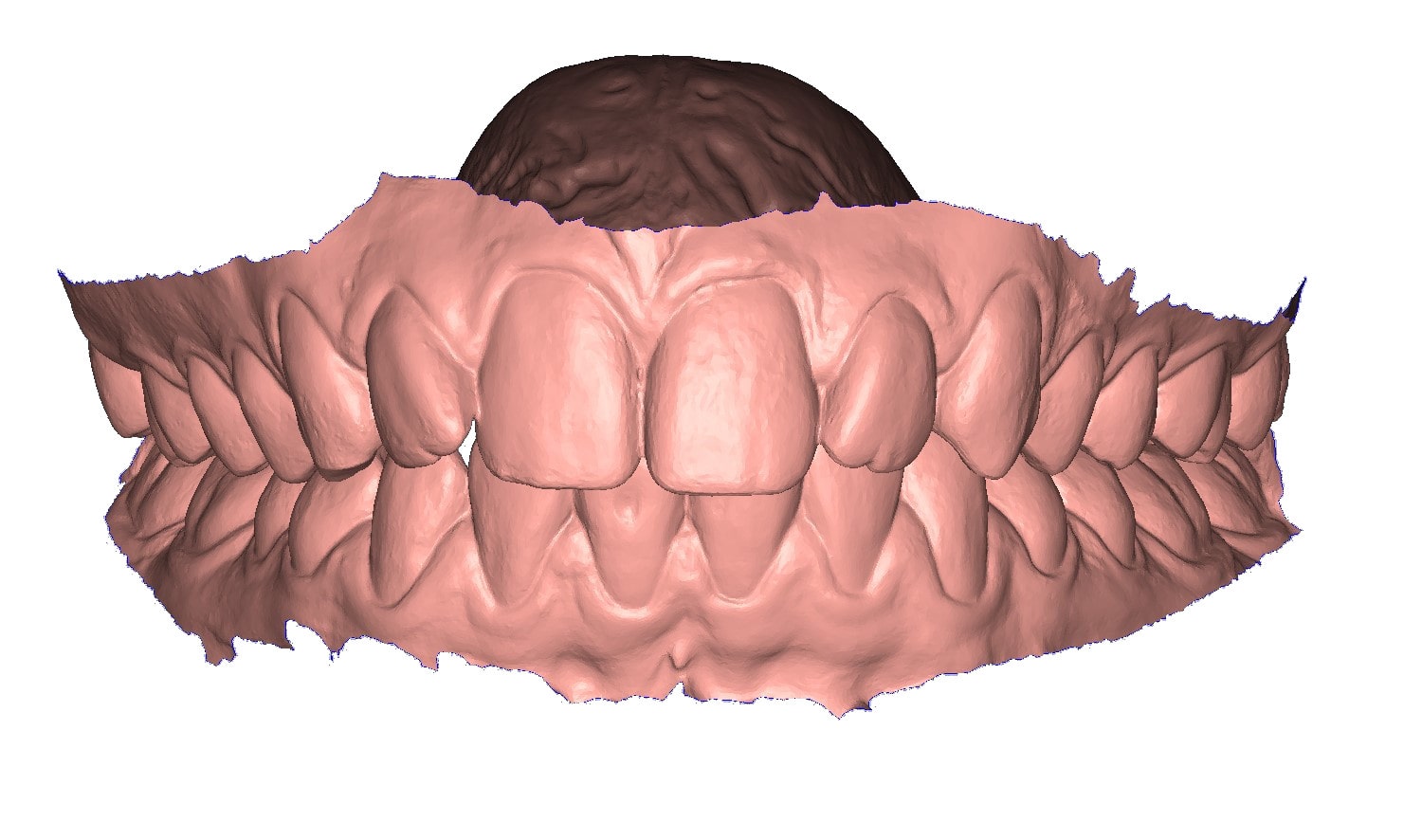 STL dental model DeltaFace