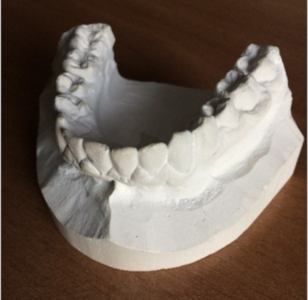 alginate dental model