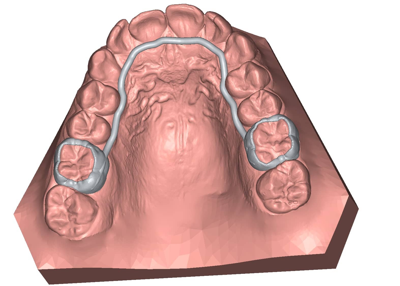 appliance arc lingual modèle 3D dentaire DeltaFace