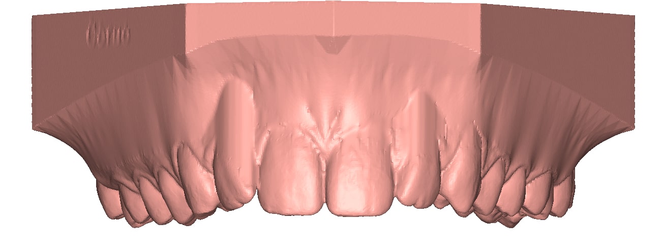 Appliance block out undercuts 3D dental model DeltaFace