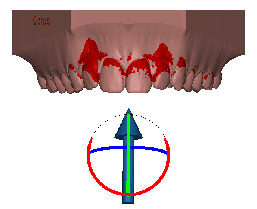 Appliance view of the undercuts 3D dental model DeltaFace