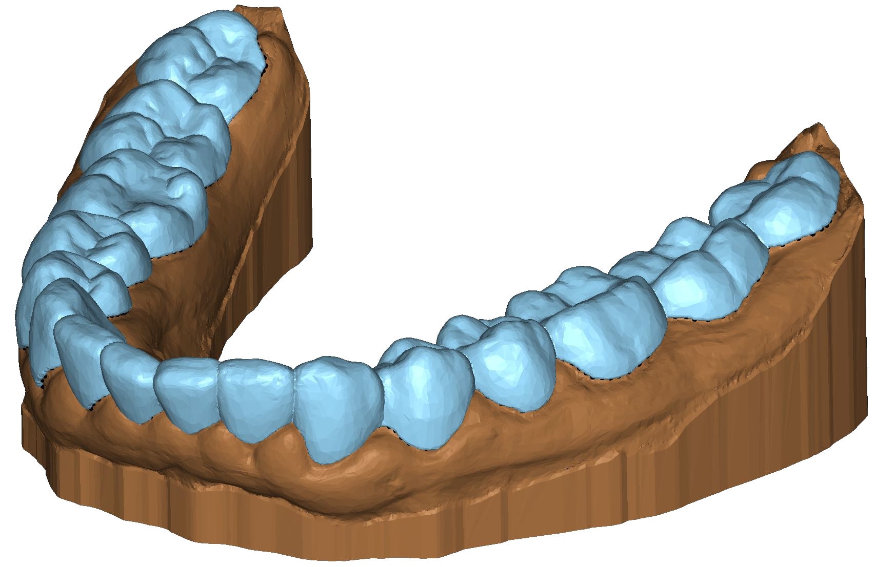 Gouttière dentaire modèle 3D Appliance DeltaFace