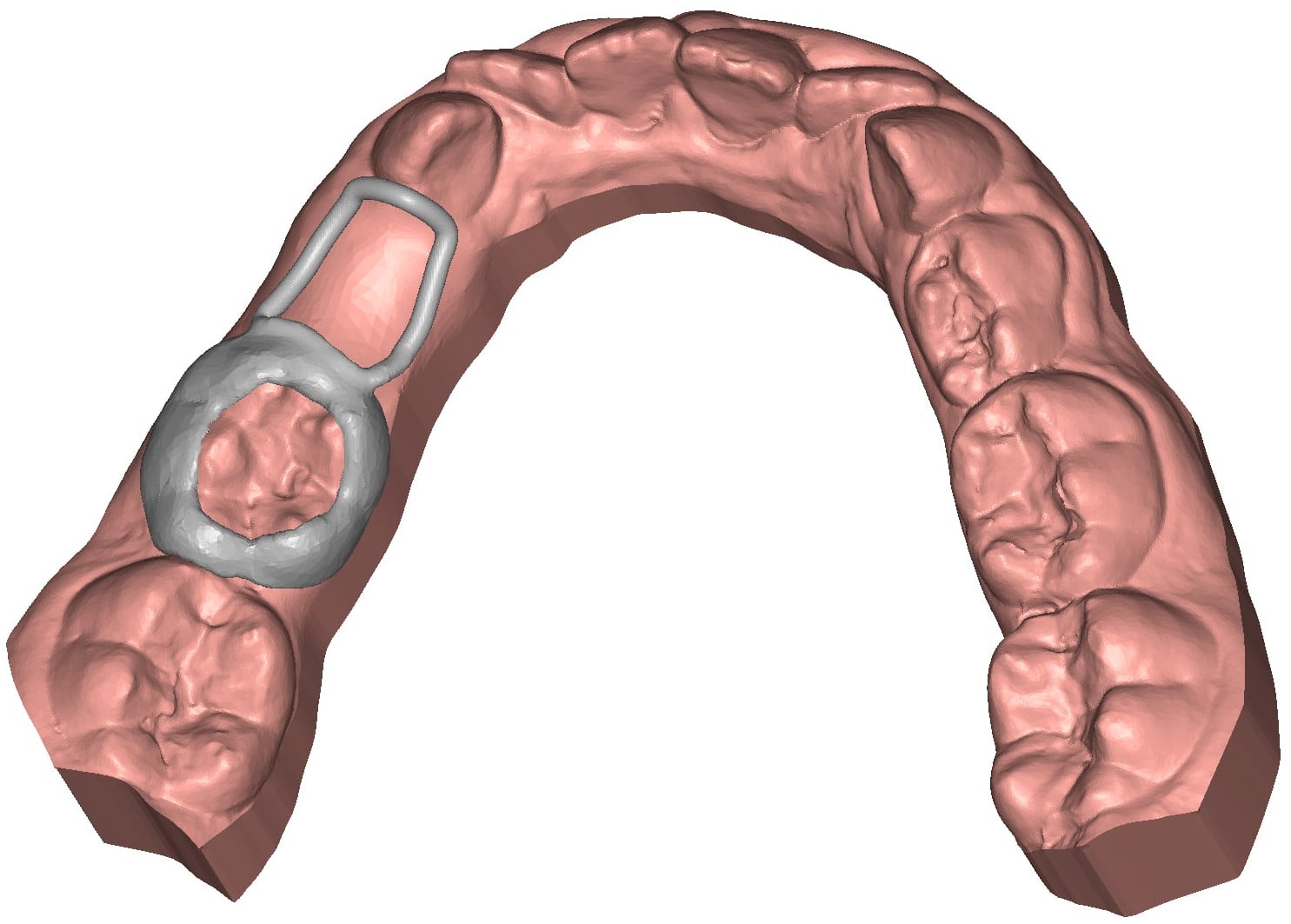 Appliance bague molaire avec mainteneur d'espace modèle 3D dentaire DeltaFace