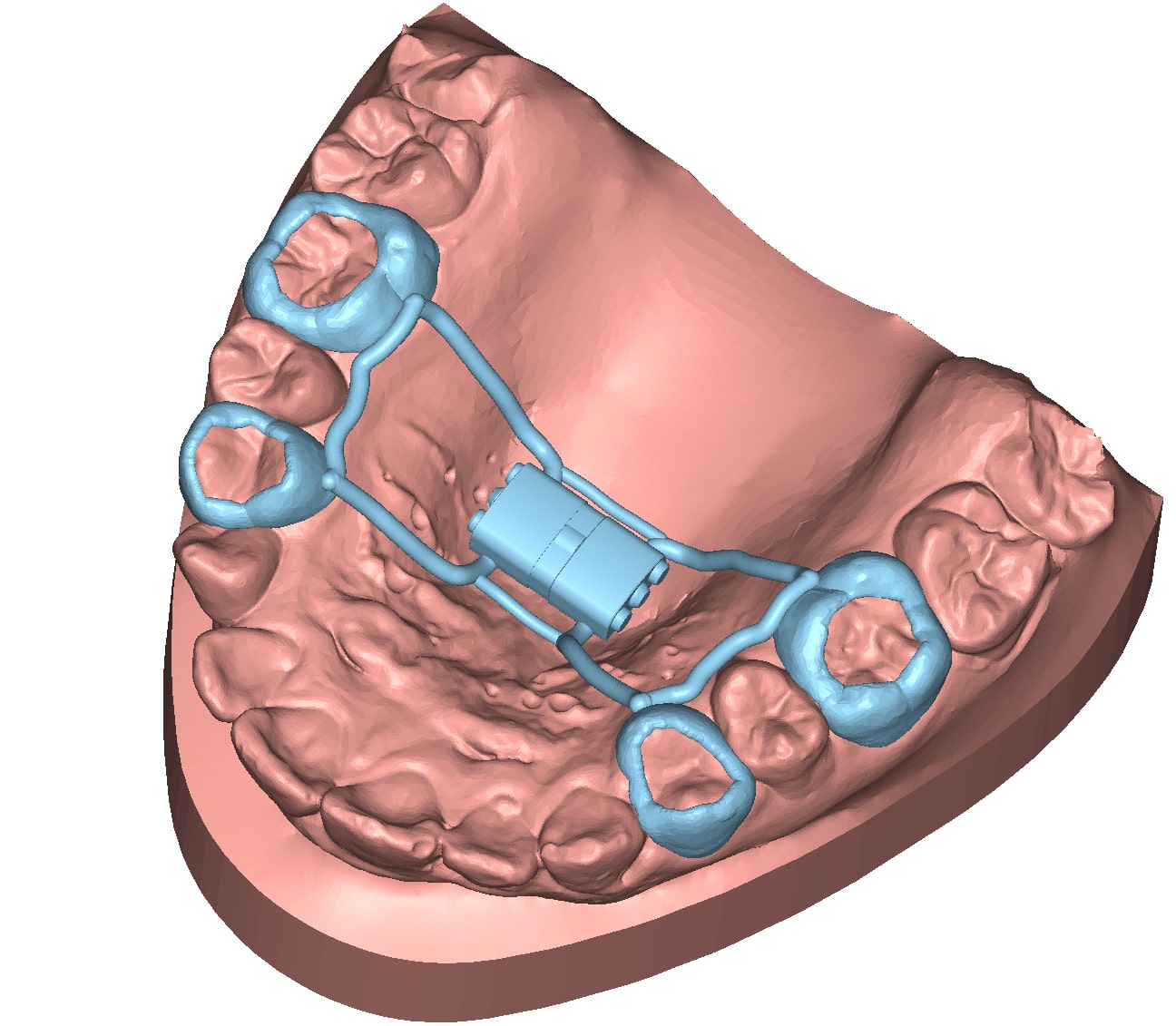 appliance hyrax virtuel modèle dentaire 3D DeltaFace