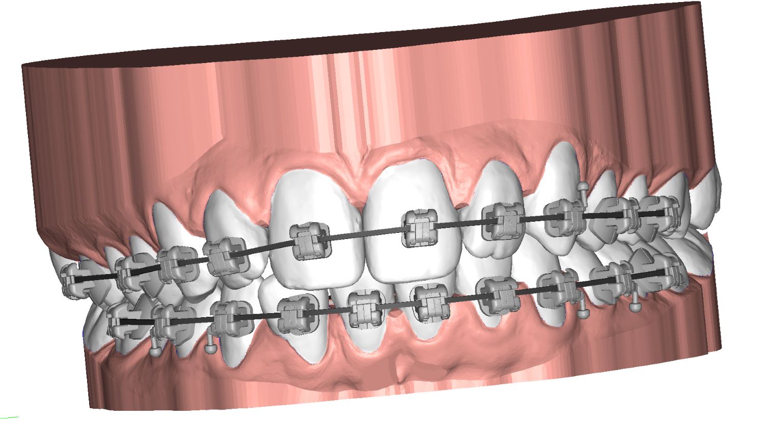 UBrackets Customised brackets 3D dental model DeltaFace