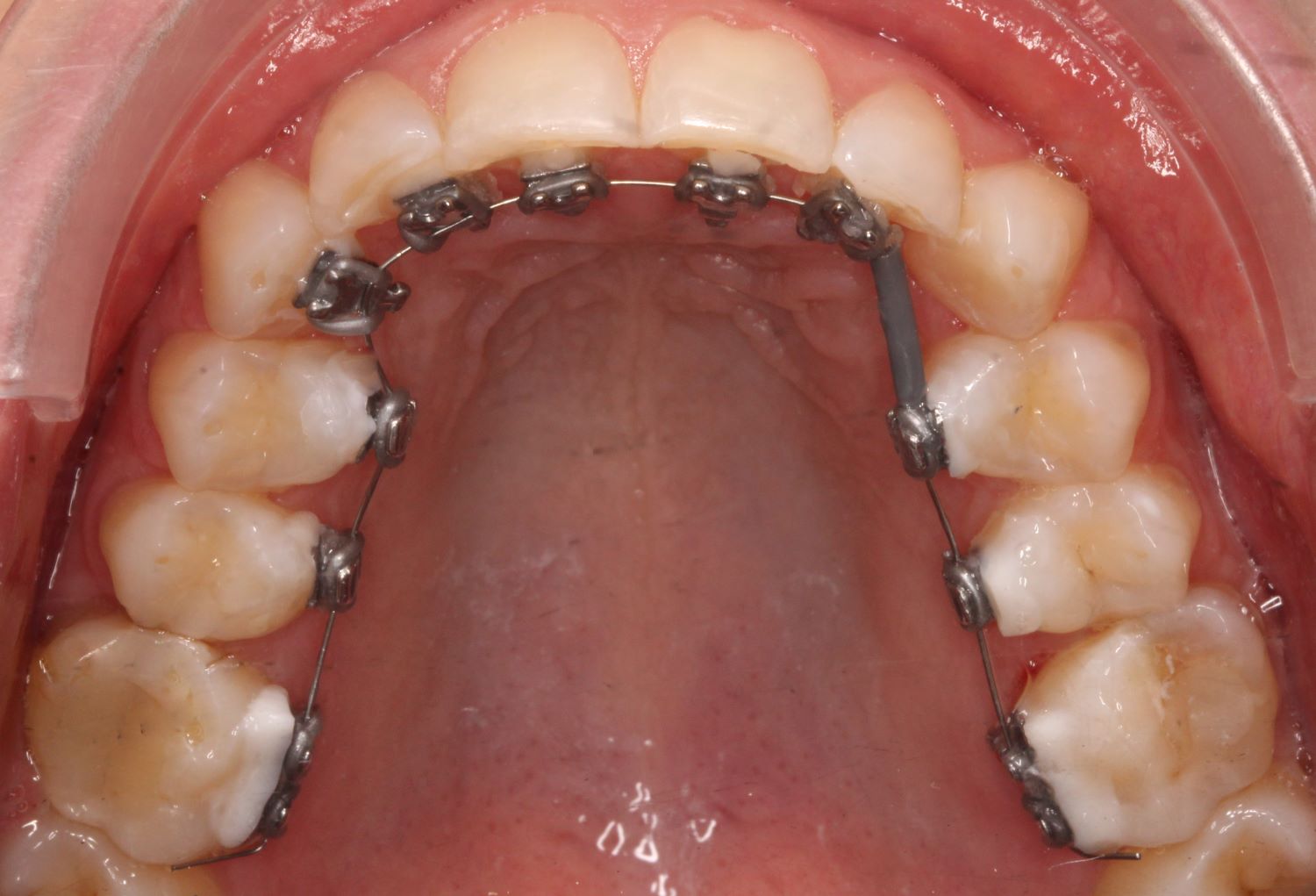 Customised lingual orthodontic brackets with archwire