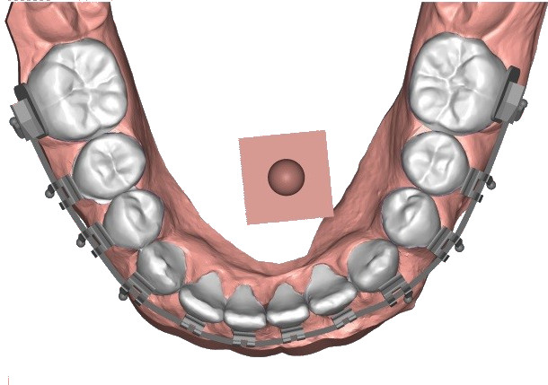 Automatic placement of the brackets on flat archwire