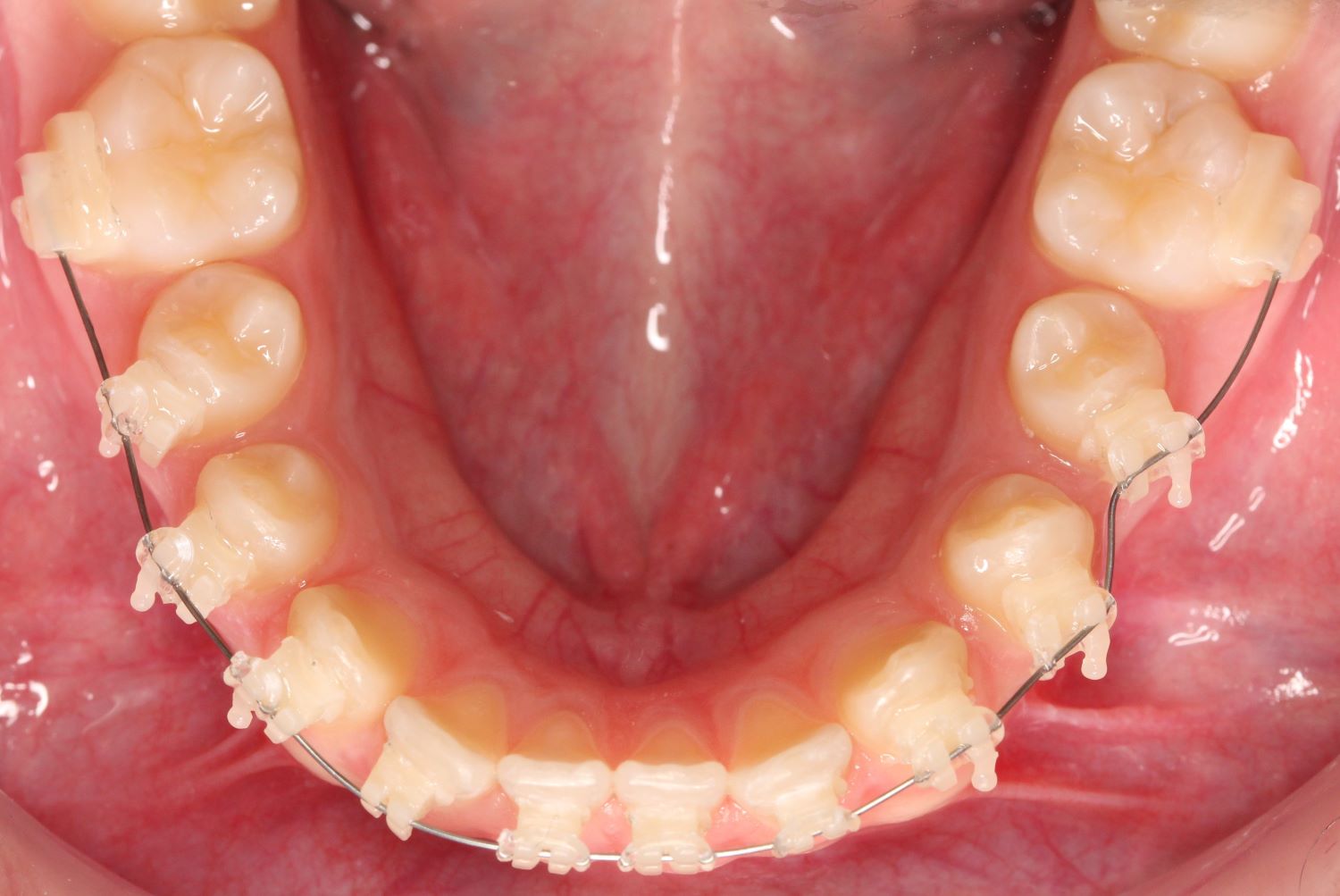 customised brackets and archwire