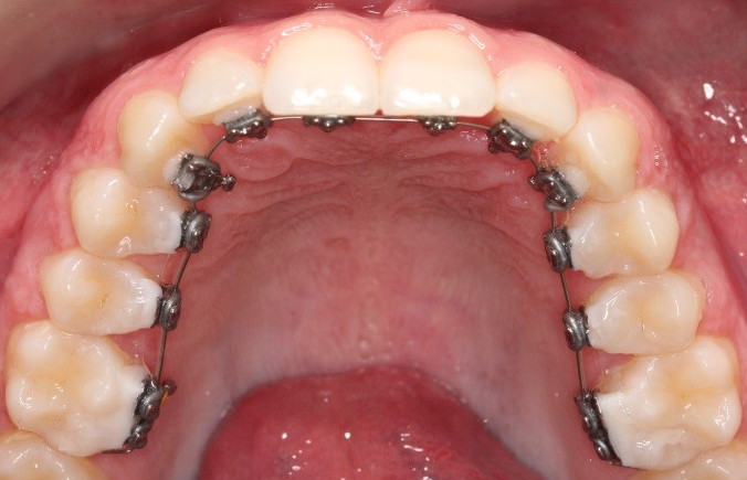 Customized lingual orthodontic brackets with NiTi archwire inserted