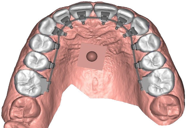 Extrusion of the brackets’ bases to the surface of the teeth