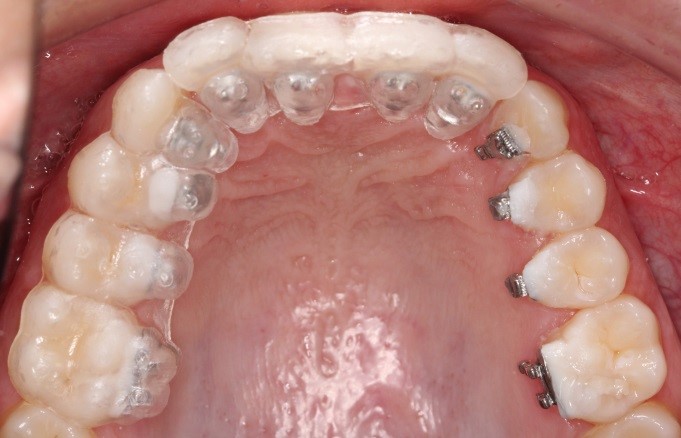 Indirect bonding using 3D printed IDB tray