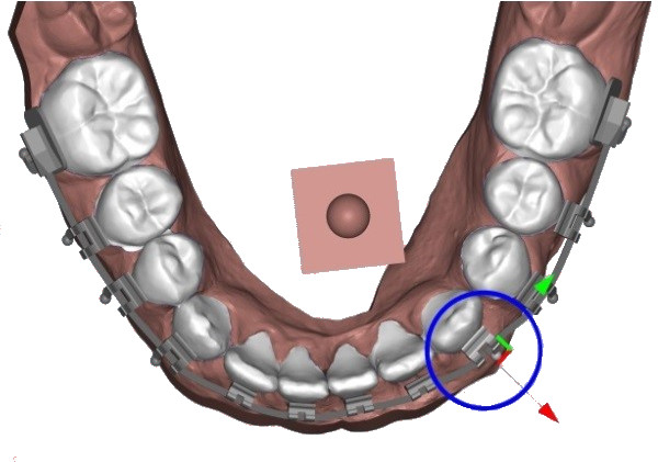 3D dental brackets with manipulator for three-dimensional positioning