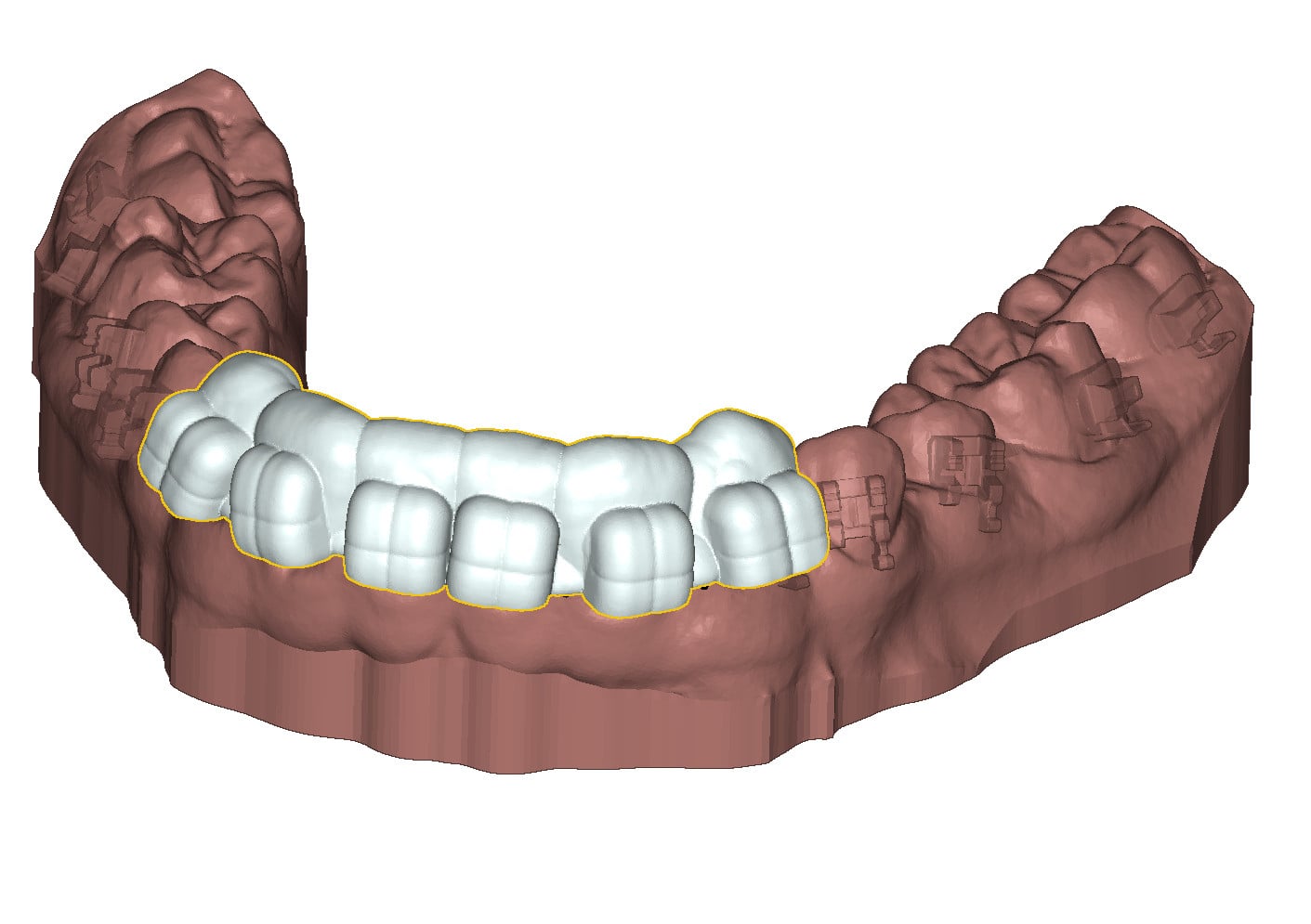 Indirect bonding tray