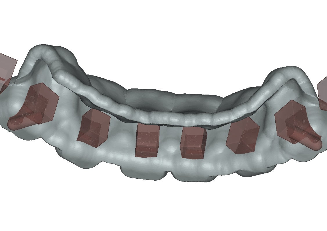 3D dental brackets with undercuts