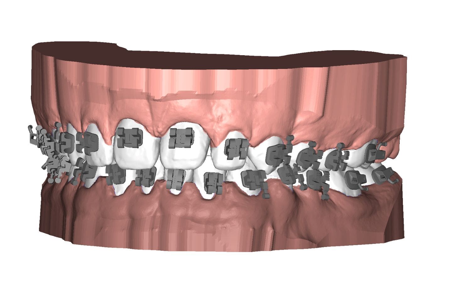 3D dental brackets