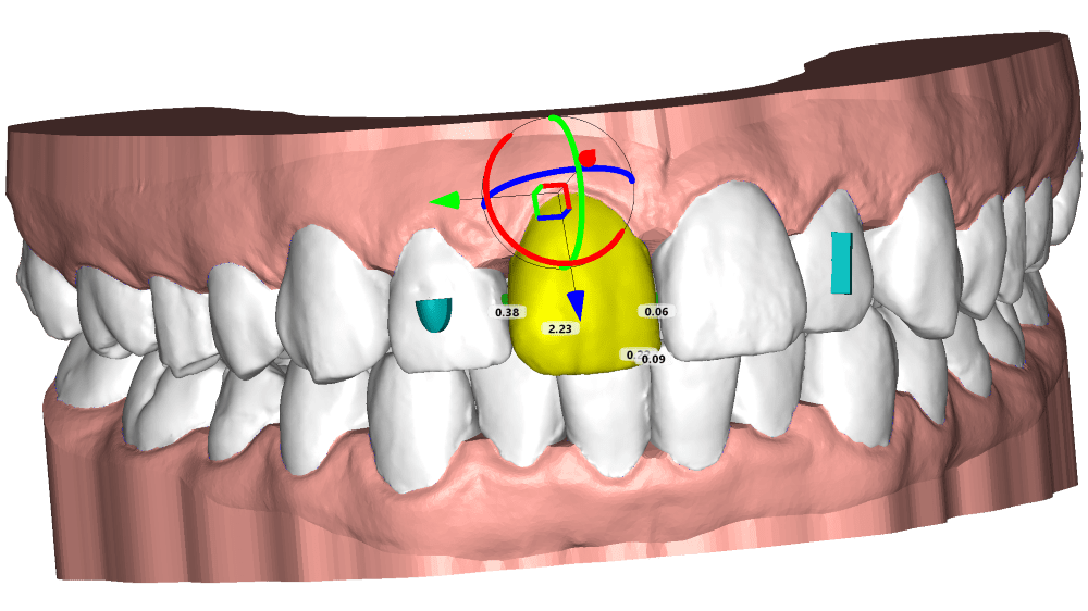 Aligner: Conception de gouttières dentaires transparentes DeltaFace