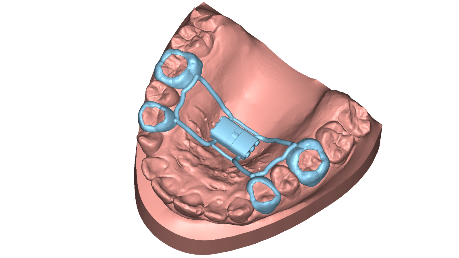 Appliance : conception d'appareils dentaires pour l'orthodontie