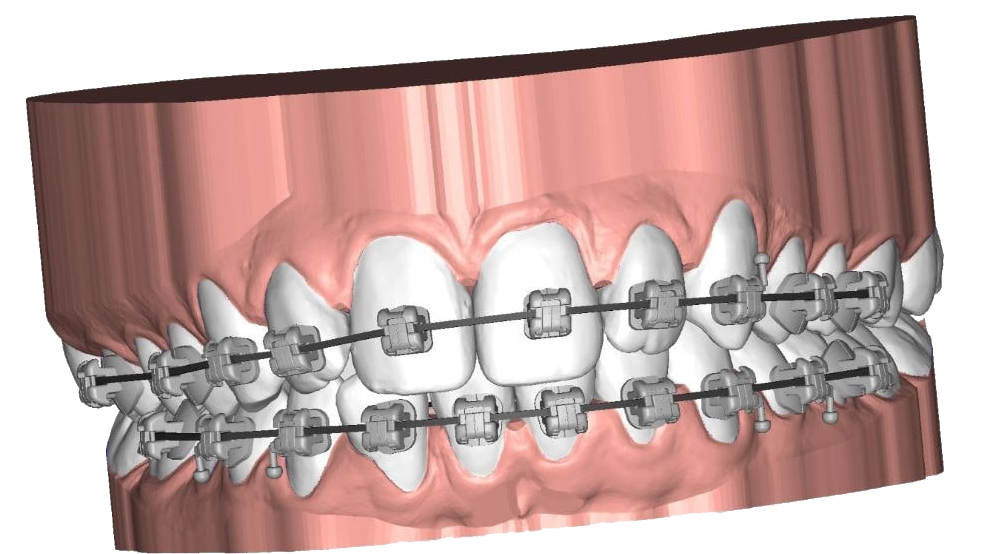 UBrackets : solutions logicielles d'orthodontie pour brackets personnalisés