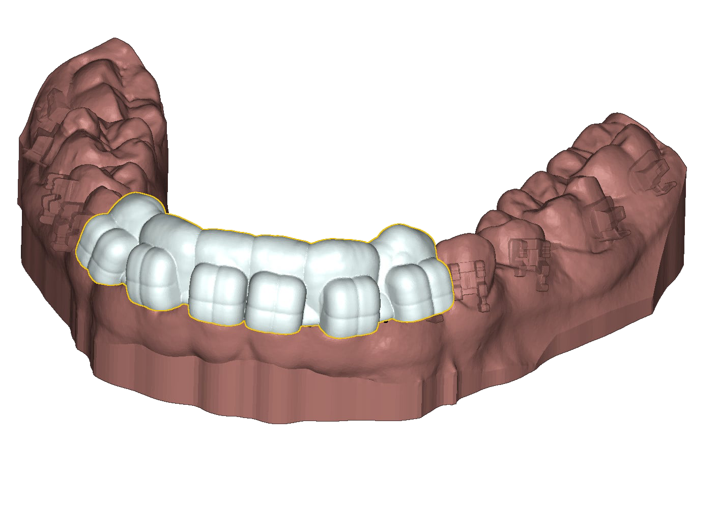 UBrackets Customised brackets and indirect bonding 3D dental model DeltaFace 