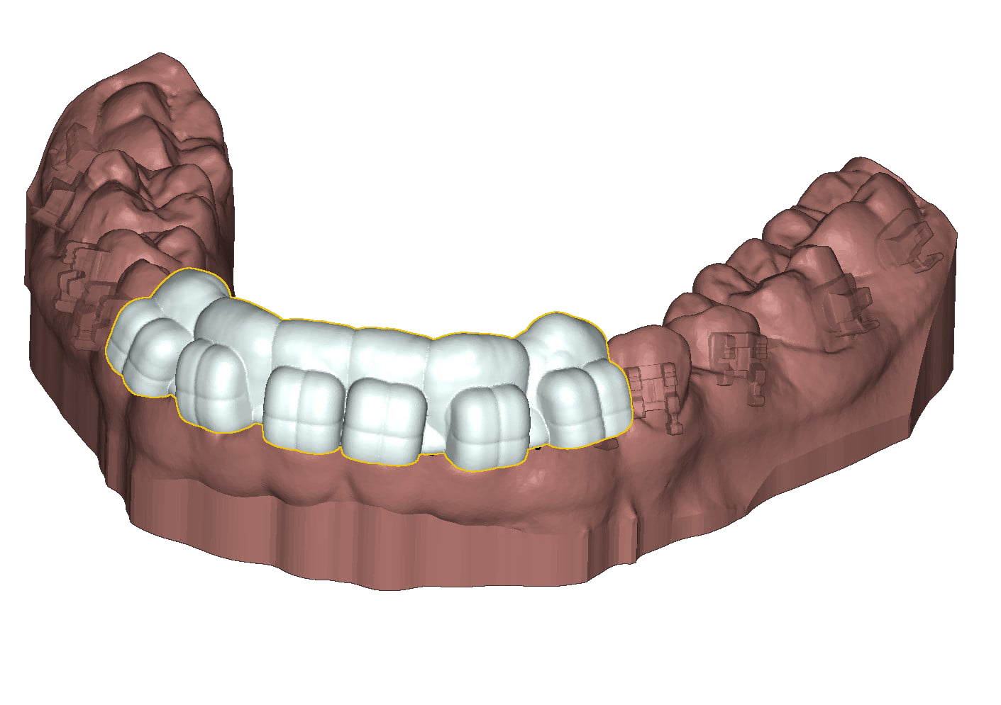 IDB: 3D Indirect bonding DeltaFace