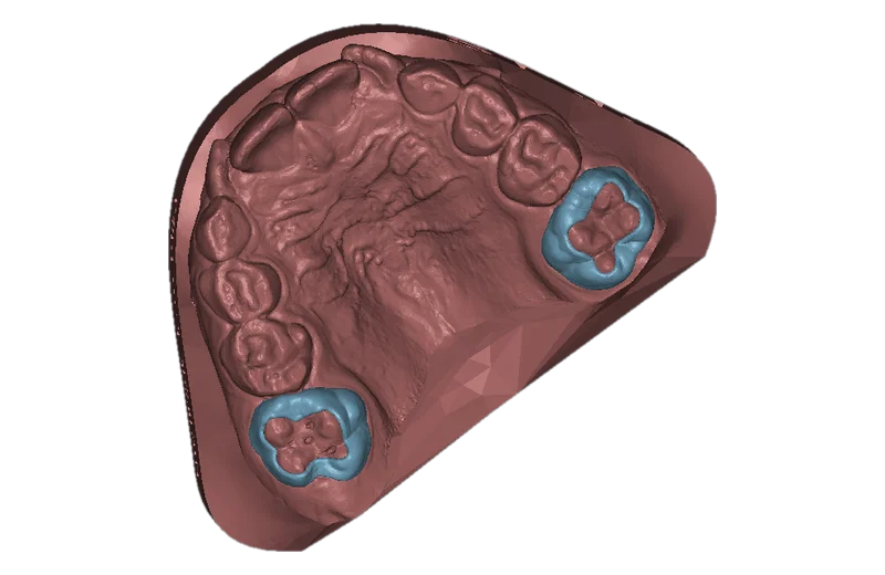 Molar bands designed with Deltaface