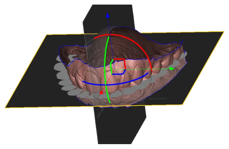 Occlusal plane in Deltaface